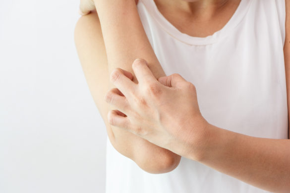 Keratosis pilaris (Reibeisenhaut): Ursachen, Behandlung & Pflege