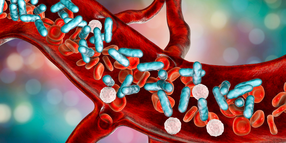sepsis nach entnahme von rückenmark